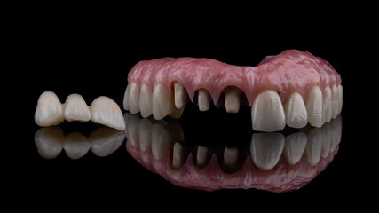 Dental implants and dentures in close-up Siemke on a black background	
