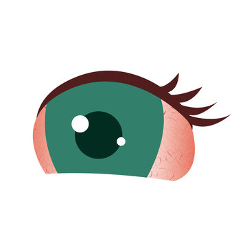 Conjunctivitis Inflammation in the human eye. Patient with blepharitis and pinkeye. Poor eyesight due to allergic reaction. Medical vector illustration