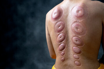 Man after cupping treatment on the back
