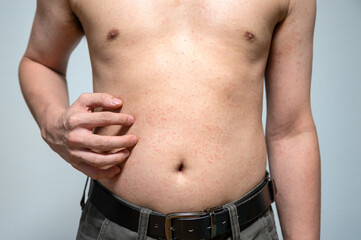 Dermatitis rash viral disease with immunodeficiency on body of young adult asian, scratching with itching