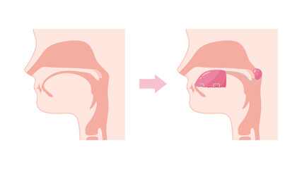 口唇口蓋裂_バルブ型スピーチエイドを装着した矢状断のイラスト_構音障害
