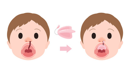口唇口蓋裂_ホッツ床を装着するイラスト_Hotz床_NAMあり © ふわぷか