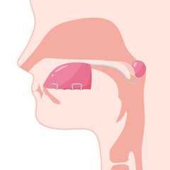 口唇口蓋裂_バルブ型スピーチエイドを装着した矢状断のイラスト_構音障害