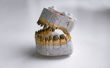 Dentistry and prosthetics. The path to beautiful teeth and good health. Dentures in human hands.