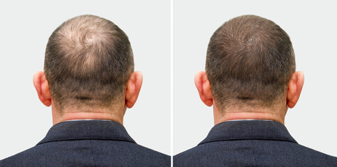 The head of a balding man before and after hair transplant surgery. A man losing his hair has...