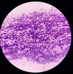 Conventional pap's smear: Reactive cellular changes associated with severe inflammation, atypical squamous cells of undetermined significance(ASCUS), selective focus