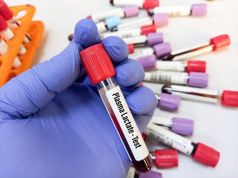 Test tube with blood sample for Plasma lactate test, Lactic acid test, laboratory background