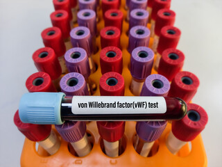 Blood sample for von Willebrand factor(vWF) antigen test, clotting factor disorder, coagulation...