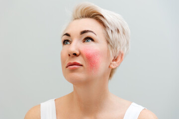 Portrait of an adult beautiful woman with redness on her cheek. The concept of rosacea and...