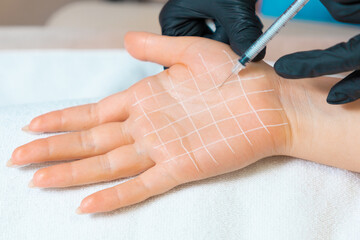 Professional cosmetology. Doctor makes injections of botulinum toxin on the female palm against...