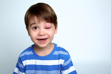 A boy with swollen eye from insect bite. Quincke edema. Close-up. Portrait of European appearance child looking at the camera and laughs. Studio background. Isolated. Face of allergic person. Allergy