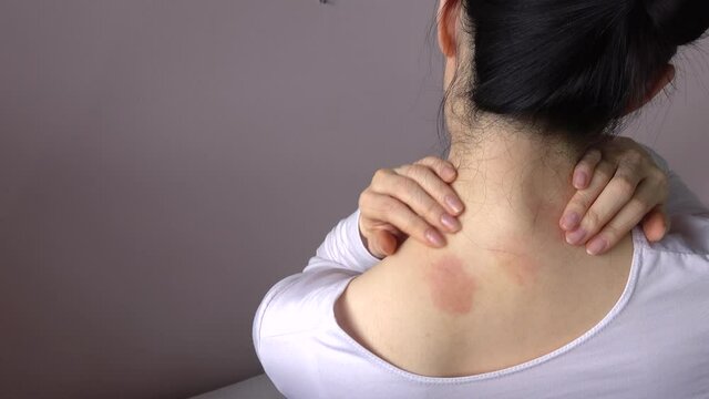 Blurred, closeup shot of a young woman scratching her neck and back. Defocus shot of itchy body with skin problem. 4K