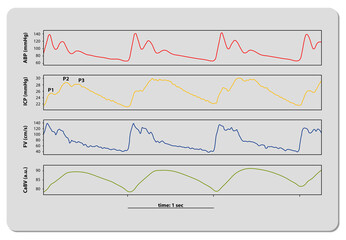 Intracranial Pressure Monitoring ICP waveform, 3d render, 2d graphic