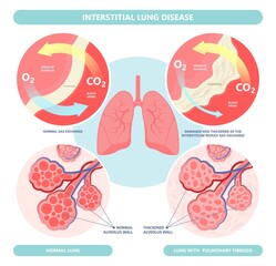 Capillary dry cough of wood metal dust breath virus Chest X-ray Cancer scan High resolution HRCT Biopsy usual COPD chronic asbestos corona covid 19 cystic diagnose disorder dyspnea fibers ILD UIP IPF