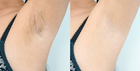 Image before and after skincare cosmetology armpits epilation treatment concept. Close up underarm...