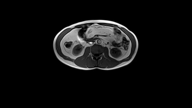 CT scan of the abdomen. Computed tomography of the gastrointestinal tract, liver and kidneys.