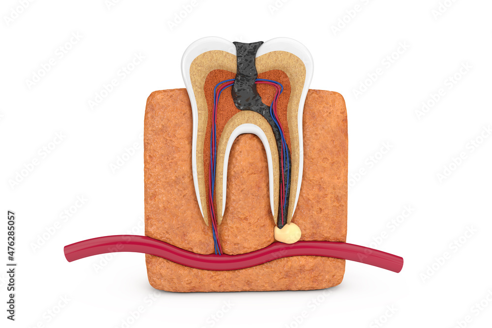Poster inside of decay tooth. 3d rendering