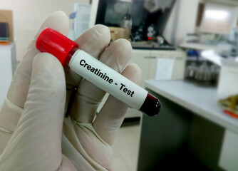 Blood sample for creatinine test. Diagnosis of kidney or renal disease