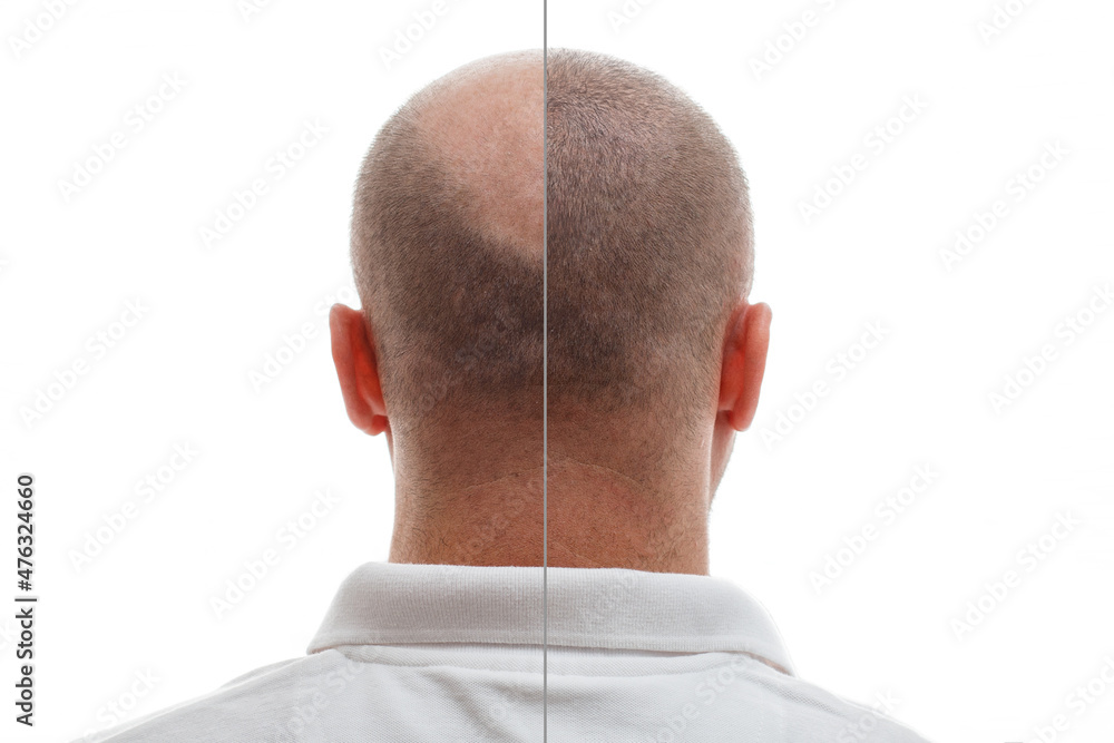 Wall mural the head of a balding man before and after hair transplant surgery. a man losing his hair has become