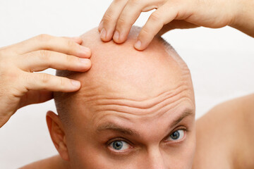 The head of a balding man. A bald man was upset because of the hair loss. Treatment of baldness.