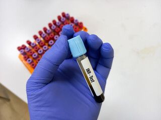Blood sample for INR test(prothrombin time test), Blood coagulation testing.