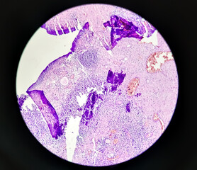 Inflammatory breast lump, Chronic nonspecific mastitis with fibrocystic changes and ductal hyperplasia, no malignant cell.