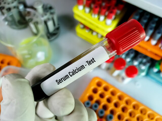 Blood sample for Serum calcium test