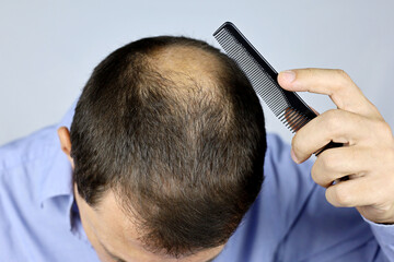 Baldness, man combing his head with a comb. Male hand on a bald, person concerned about hair loss