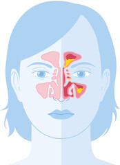 Sinusitis, vector illustration