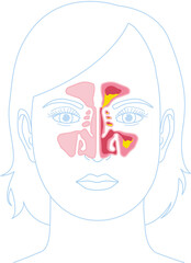 Sinusitis, vector illustration