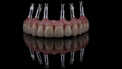 Dental implants and dentures in close-up Siemke on a black background	
