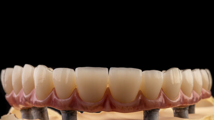 Dental implants and dentures in close-up Siemke on a black background	
