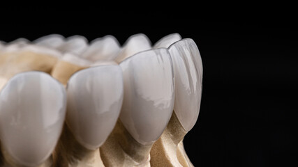 Dental implants and dentures in close-up Siemke on a black background	
