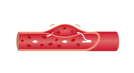 Vector illustration of aortic dissection (no text)
