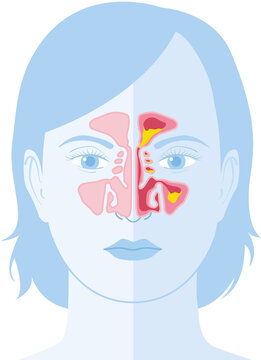 sphenoid sinus