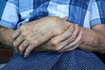Age spots on hands. They are brown, gray, or black spots and also called liver spots, senile...
