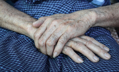 Age spots on hands. They are brown, gray, or black spots and also called liver spots, senile...