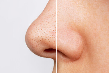 Close-up of woman's nose with blackheads or black dots before and after peeling, cleansing the face isolated on a white background. Acne problem, comedones. Profile. Cosmetology dermatology concept - obrazy, fototapety, plakaty