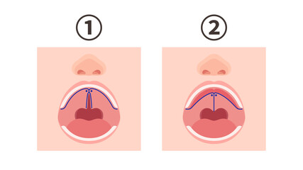 口唇口蓋裂_口蓋裂の手術方法のイラスト_pushback法