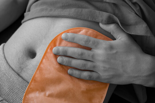 male patient with an ostomy pouch in skin color. He placed his hand on the colostomy bag. only the stoma bag is colored.