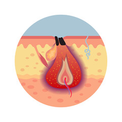 Propionibacterium acnes vulgaris. schematic representation of the focus of inflammation under the skin. Development of pimples. vector medical Illustration for dermatology