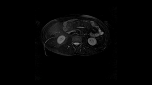 CT scan of the abdomen. Computed tomography of the gastrointestinal tract, liver and kidneys.