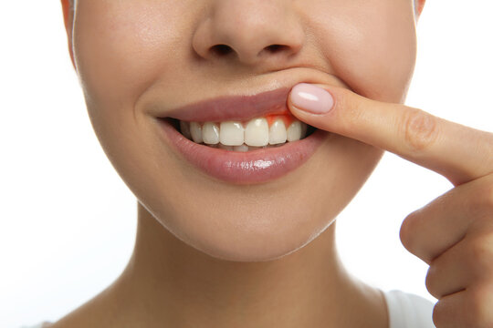 Young Woman Showing Inflamed Gums, Closeup View