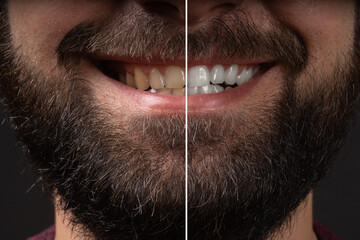 Smiling man before and after teeth whitening procedure, closeup. whitening teeth laser bleach in male man tooth compare before after treatment in dental clinic