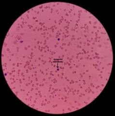 Leishman's stain microscopic show Leuco-erythroblastic anemia with thrombocytopenia, severe anemia, nRBC present.