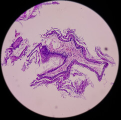 Ear and mastoid(biopsy): Microphotograph of Cholesteatoma, show keratinized stratified squamous...