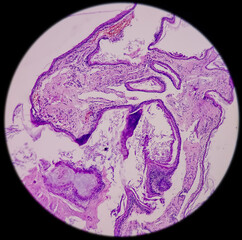 Ear and mastoid(biopsy): Microphotograph of Cholesteatoma, show keratinized stratified squamous...
