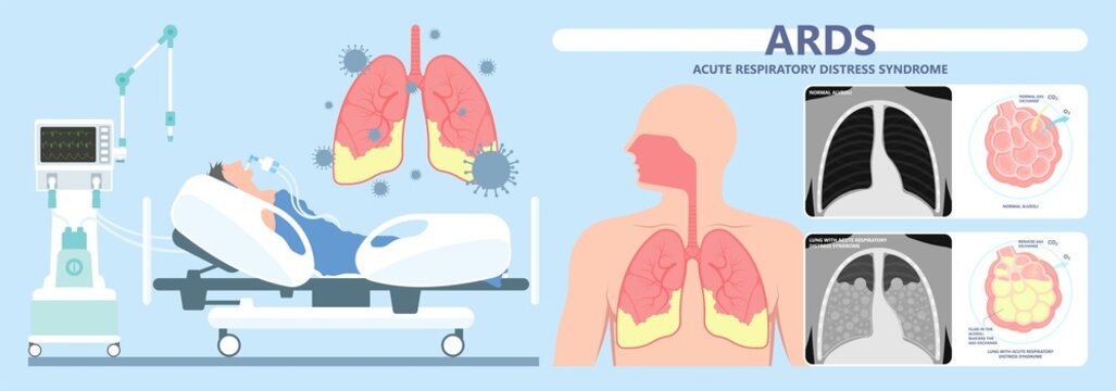 Acute Respiratory Distress Syndrome (ARDS) A Respiratory Failure And Inflammation In The Lungs Equipment Hospital Emphysema Fibrosis Idiopathic Cystic Collapsed Pneumothorax Embolism X-Ray Chest ICU