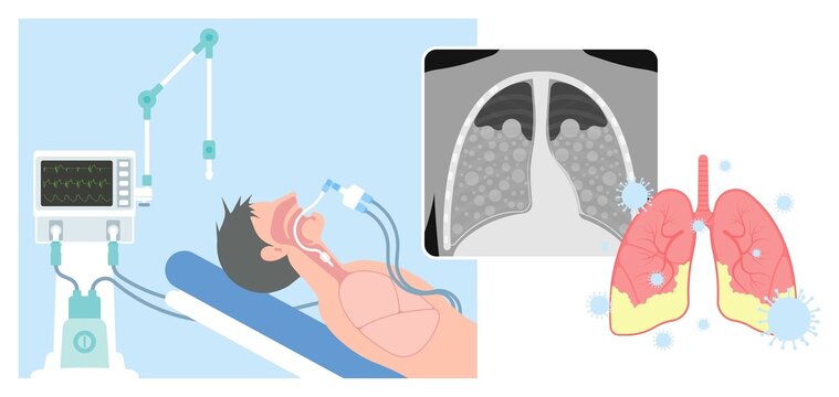 Acute respiratory distress syndrome (ARDS) a respiratory failure and inflammation in the lungs equipment hospital Emphysema fibrosis idiopathic Cystic Collapsed pneumothorax embolism X-Ray chest ICU