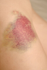 Big bruise on the leg. Big bruise on the leg.  The concept of violence, sports trauma and various...